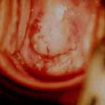 Ιαθείσα εκτοπία προσθίου χείλους